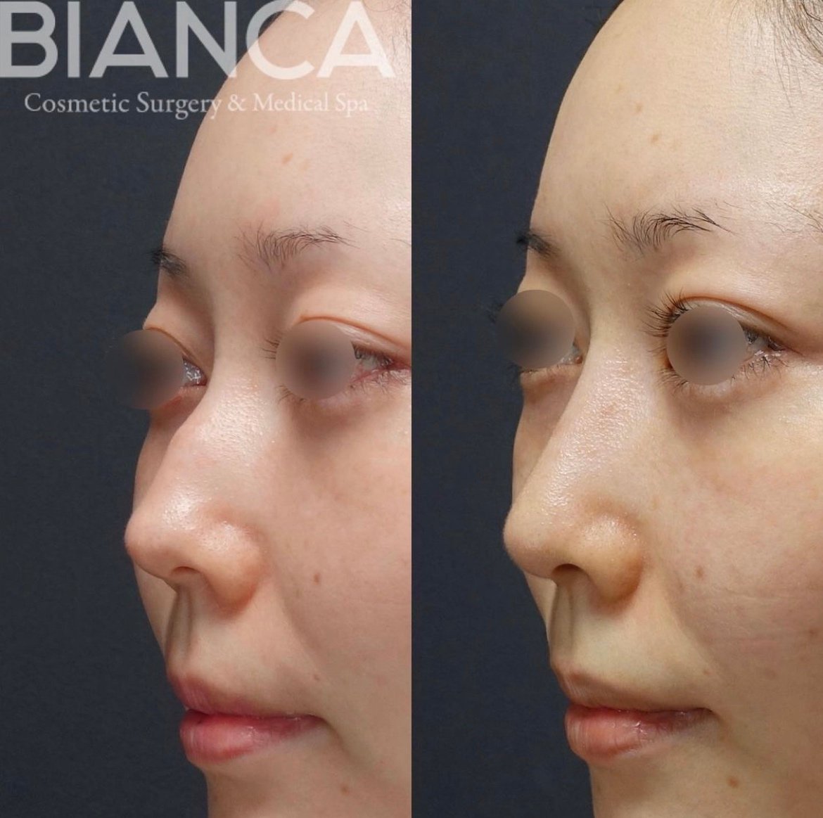 鼻骨骨切り・ハンプ切除・鼻中隔延長・鼻尖形成・耳介軟骨移植・シリコンプロテーゼ・シリコンプロテーゼ抜去