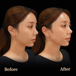 エラヒアルロン酸症例-ビアンカクリニック