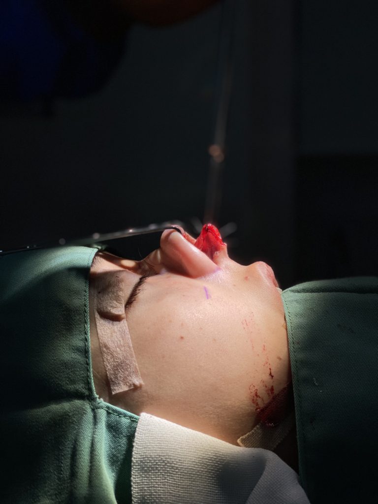 鷲鼻治療　鼻先のポテンシャル