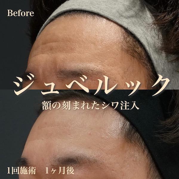 ジュベルックはなぜ額のシワに効くの？注目のスキンブースターをビアンカドクターが解説
