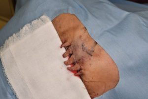 フェイスリフト手術