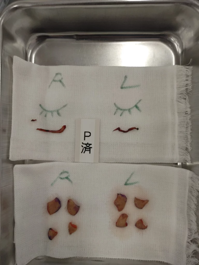 こみかみ部の余剰皮膚