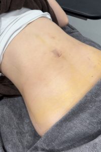 アブクラックス形成(脂肪吸引) 術後7日目