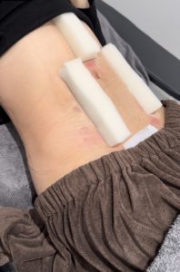 アブクラックス形成(脂肪吸引) 術後3日目