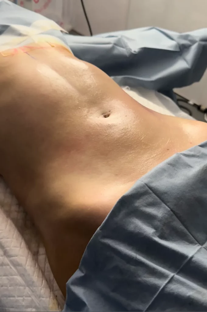 脂肪吸引のダウンタイムはどんな感じ？術後7日間の経過を医師が解説