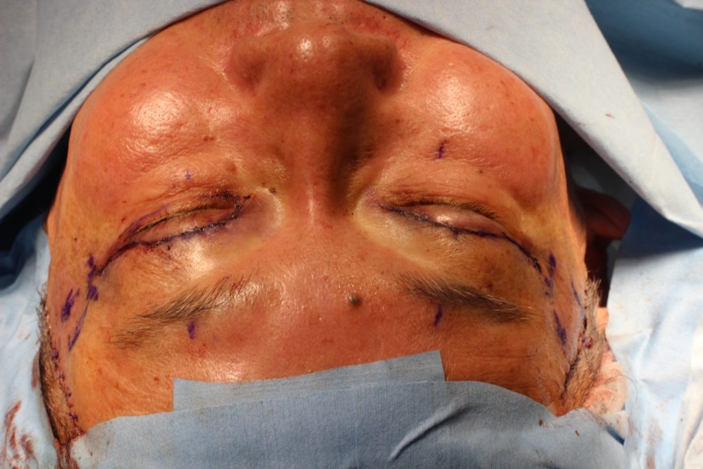 フェイスリフト　foxyeyes