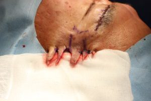 フェイスリフト手術