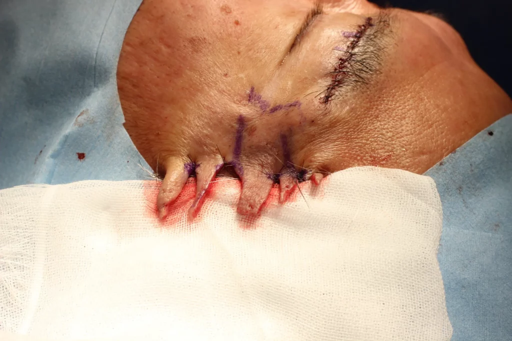 今年最後は、こめかみリフト