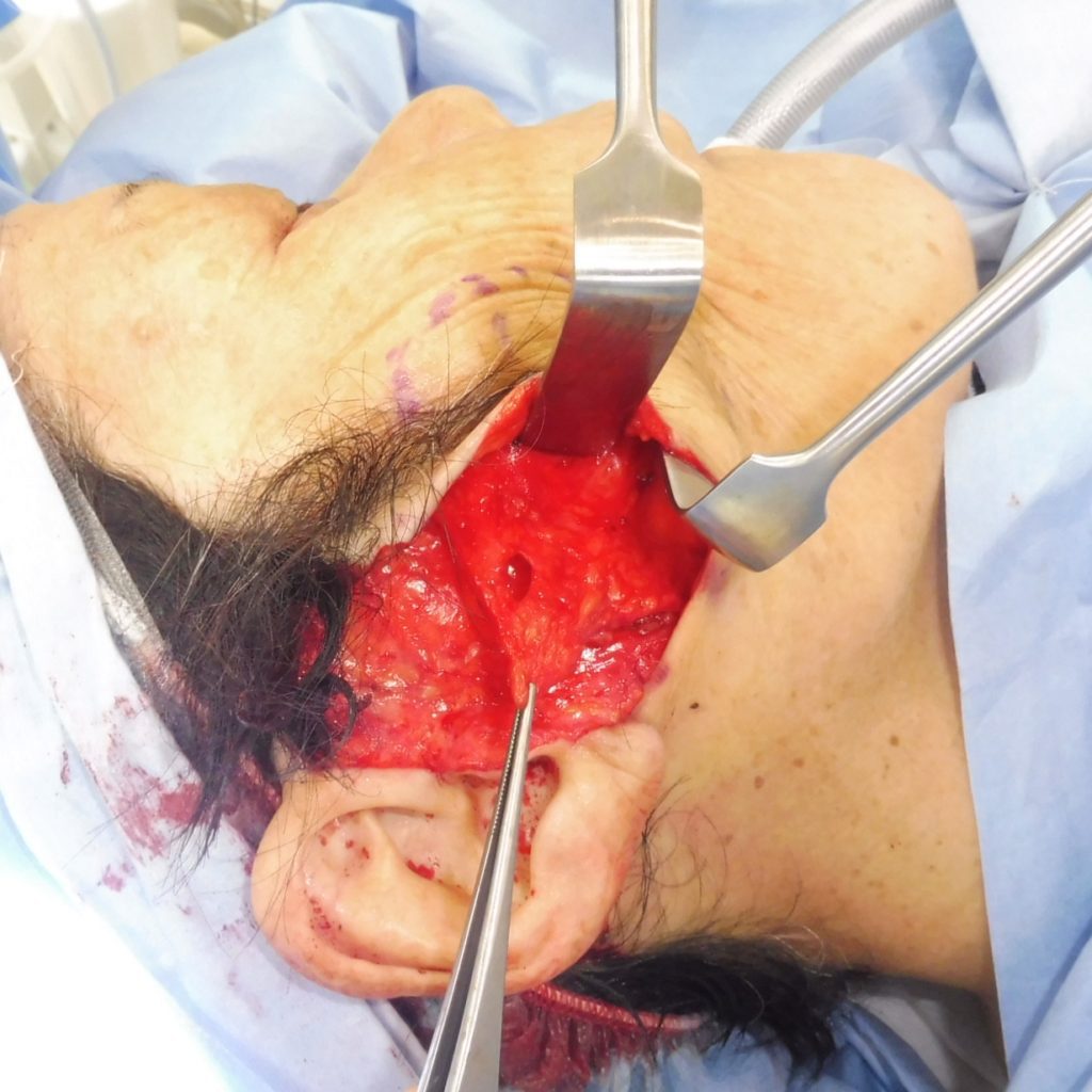 フェイスリフト手術　ハイスマス法