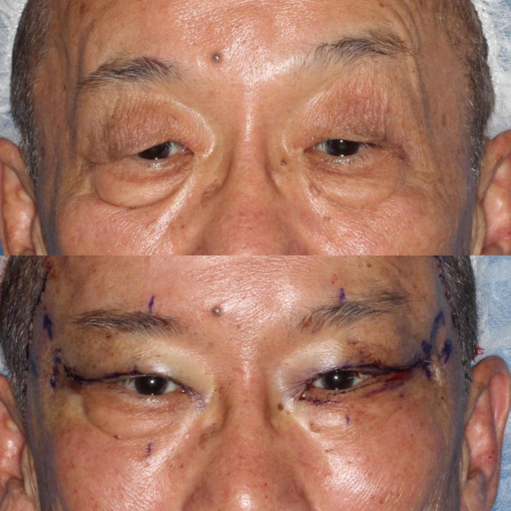 まぶたが重い…こめかみリフトで上まぶたすっきり！【症例紹介】