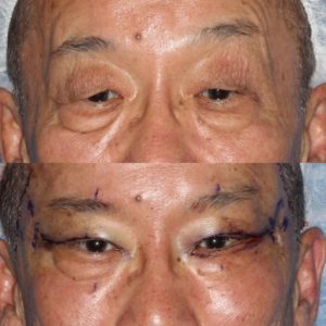 こめかみリフト症例写真