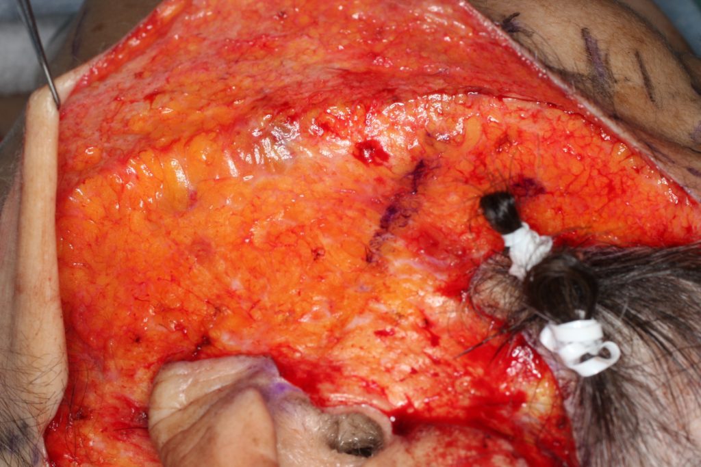 健康なSMAS フェイスリフト手術