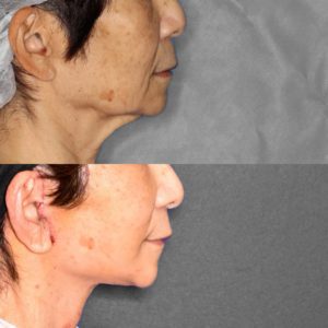 フェイスリフト手術