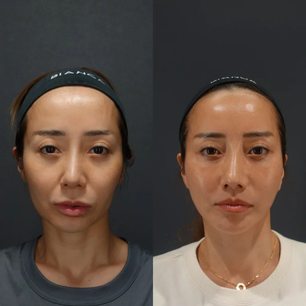 ディーププレーンフェイスリフト症例紹介｜こめかみリフト併用