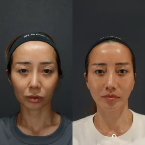 中尾崇医師によるこめかみリフトディーププレーンフェイスリフト症例