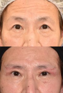 フェイスリフト手術