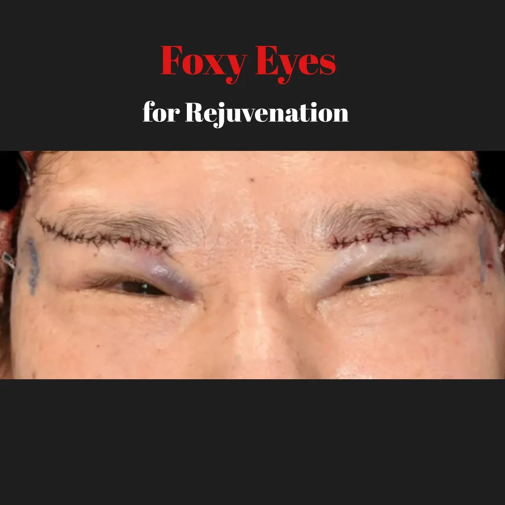 こめかみリフト　つり上がった目尻はどうなる？