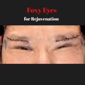 フェイスリフト手術