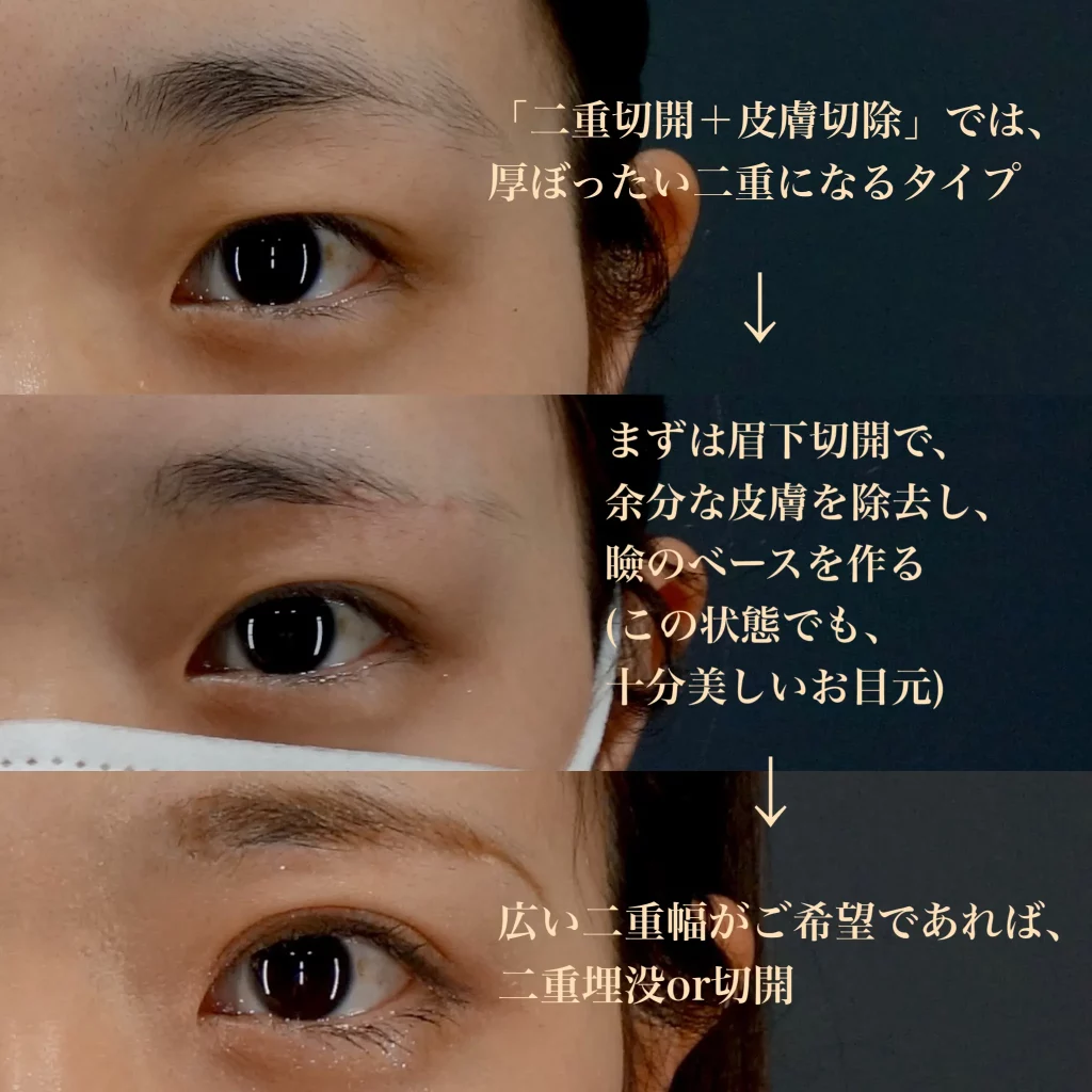 瞼が厚い人は二重になりにくい？実態をビアンカドクターが解説