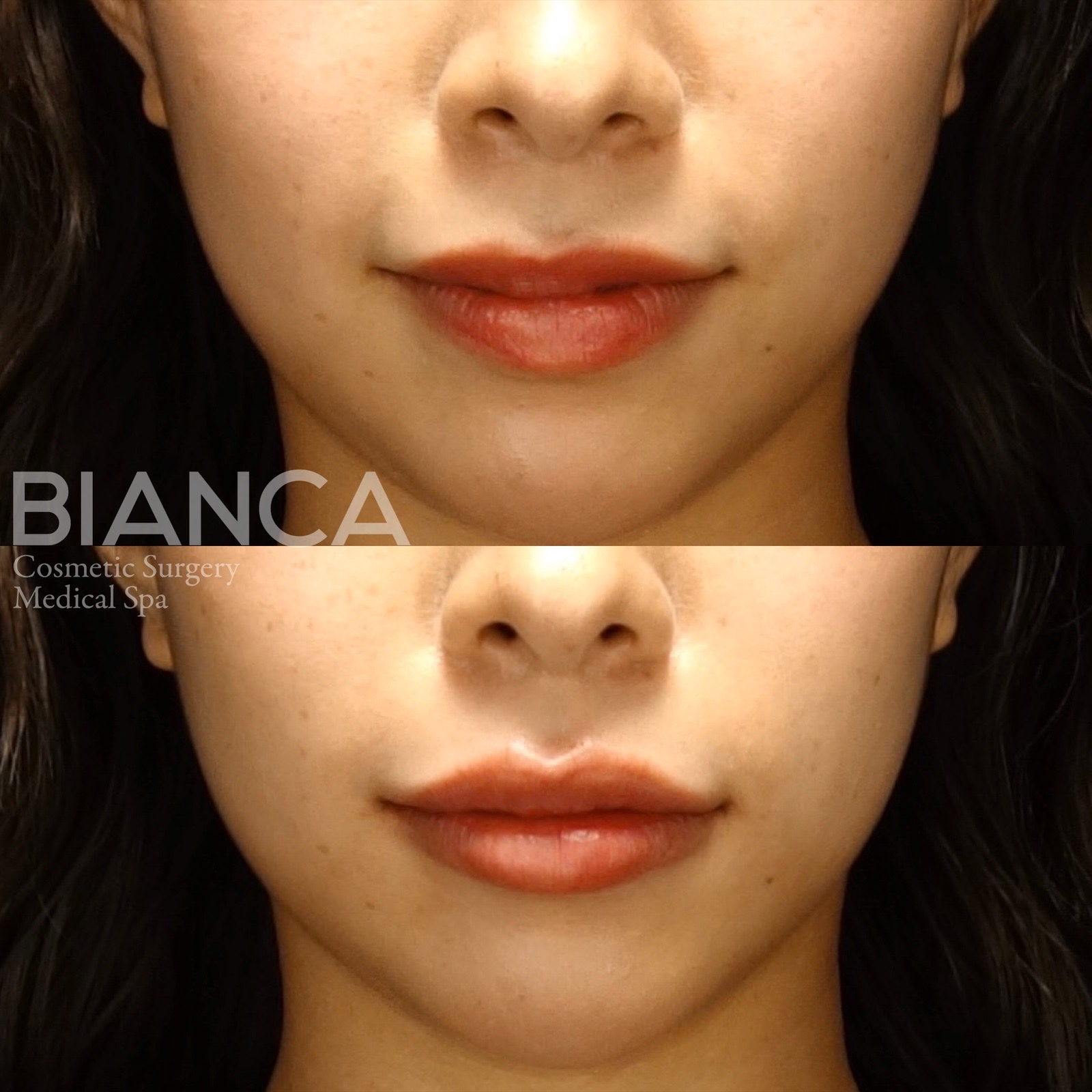 ヒアルロン酸(唇)