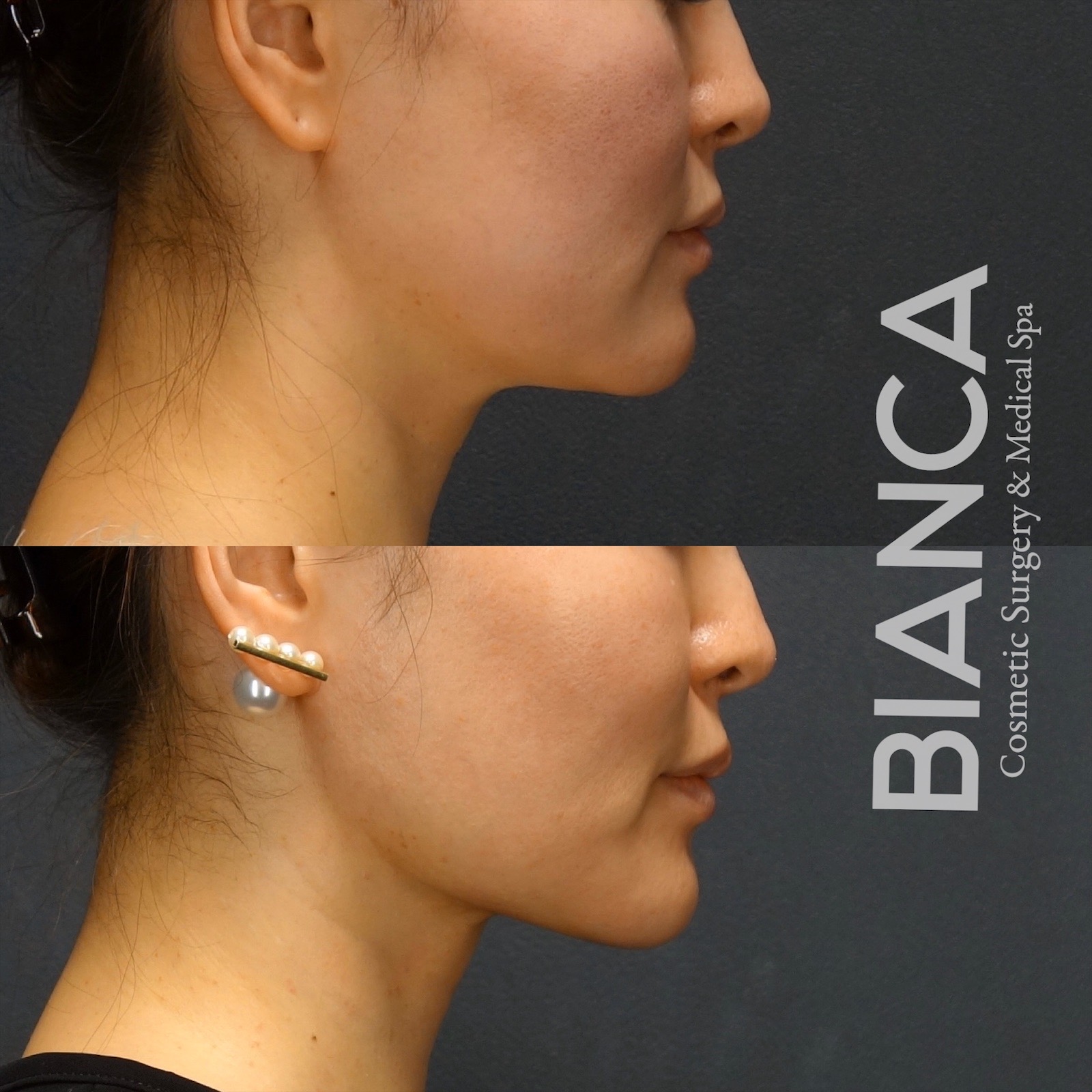 脂肪吸引✖スレッドリフト