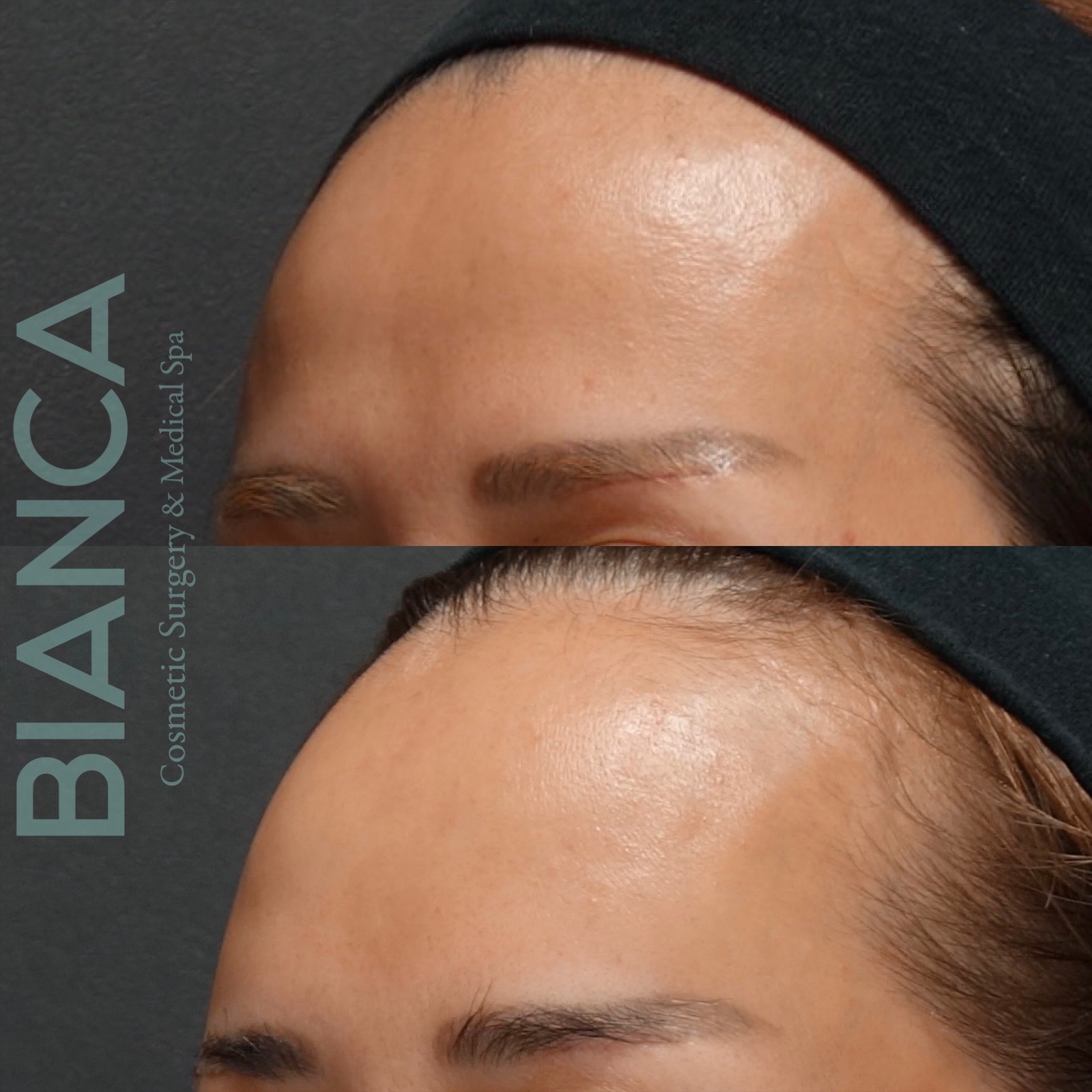 ヒアルロン酸 Juvederm VOLUMA 2ml（額）