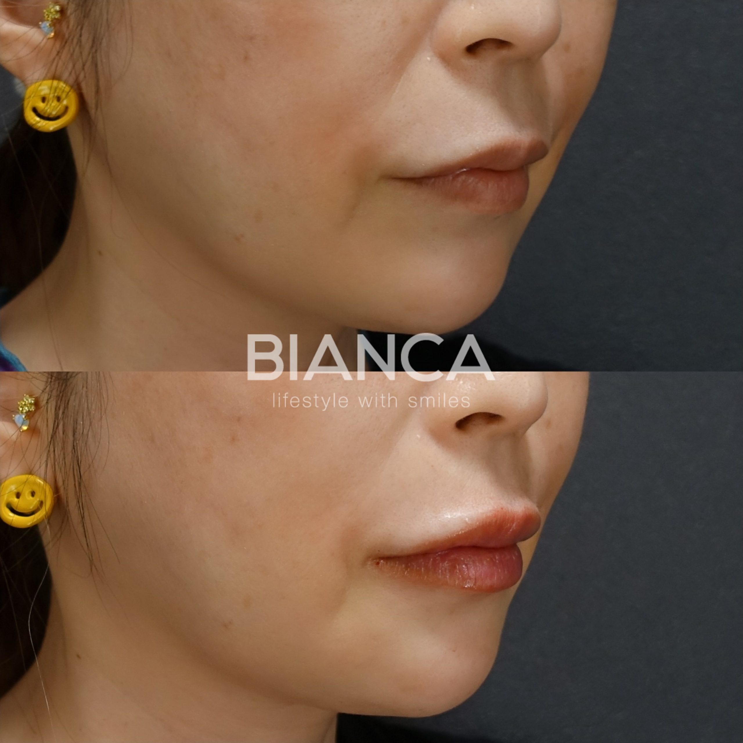 ヒアルロン酸(唇)