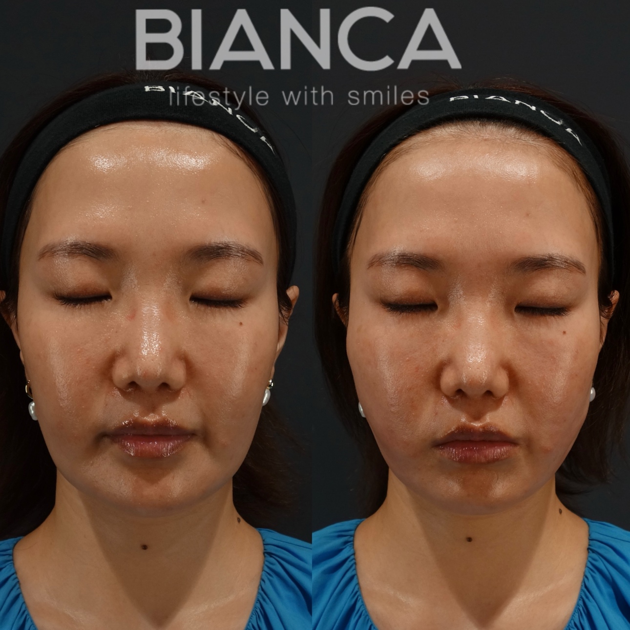 ビアンカリフト