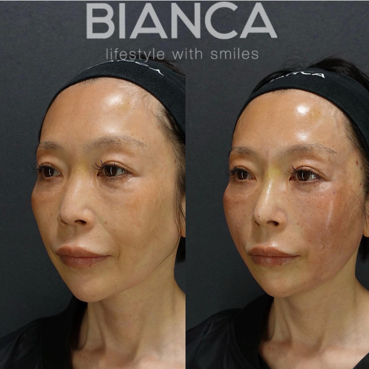 ビアンカリフト