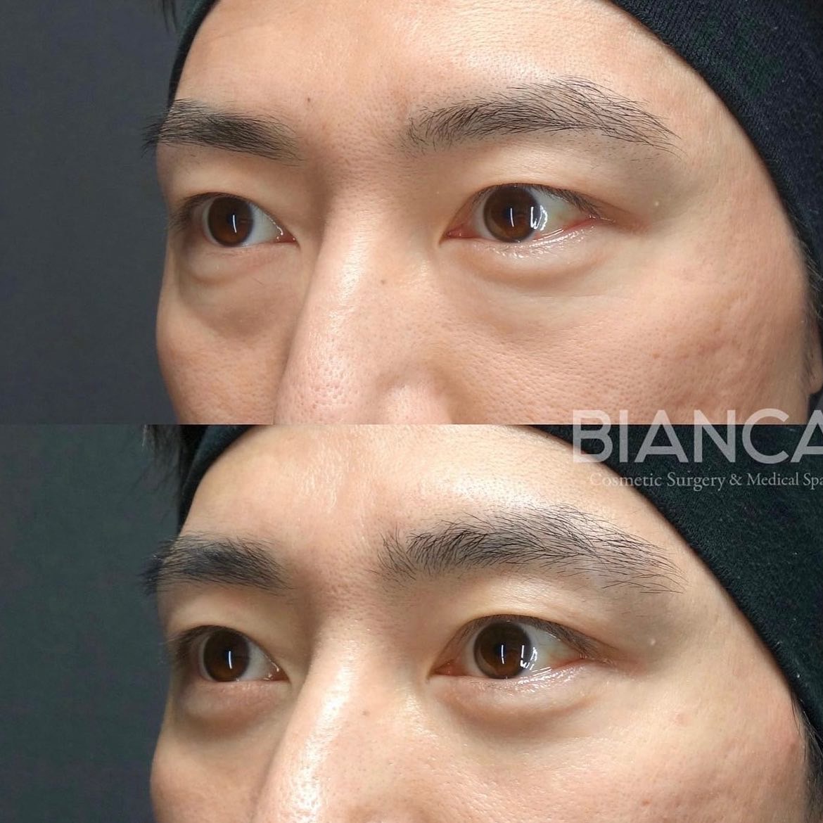 目の下クマたるみ取り(脱脂)