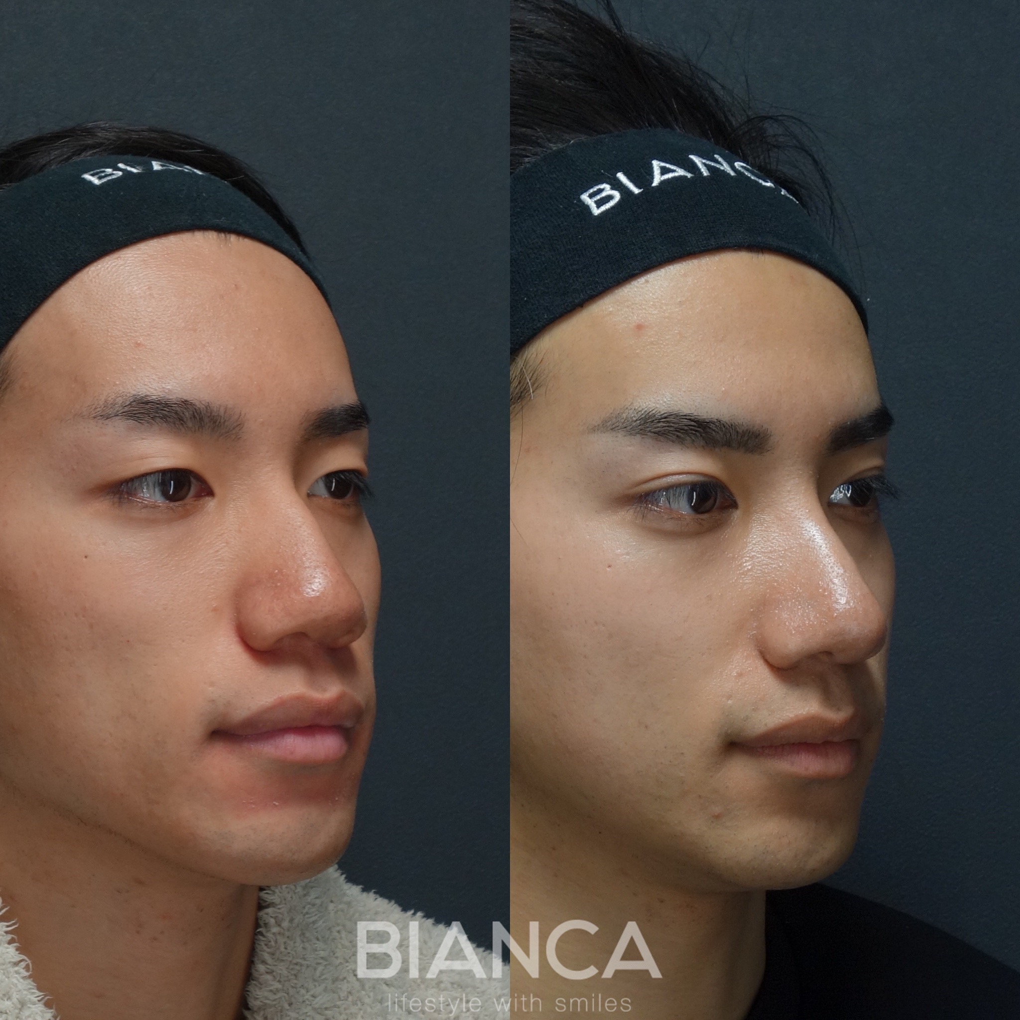 鼻中隔延長・鼻尖形成・鼻骨骨切り幅寄せ・埋没法4点留め