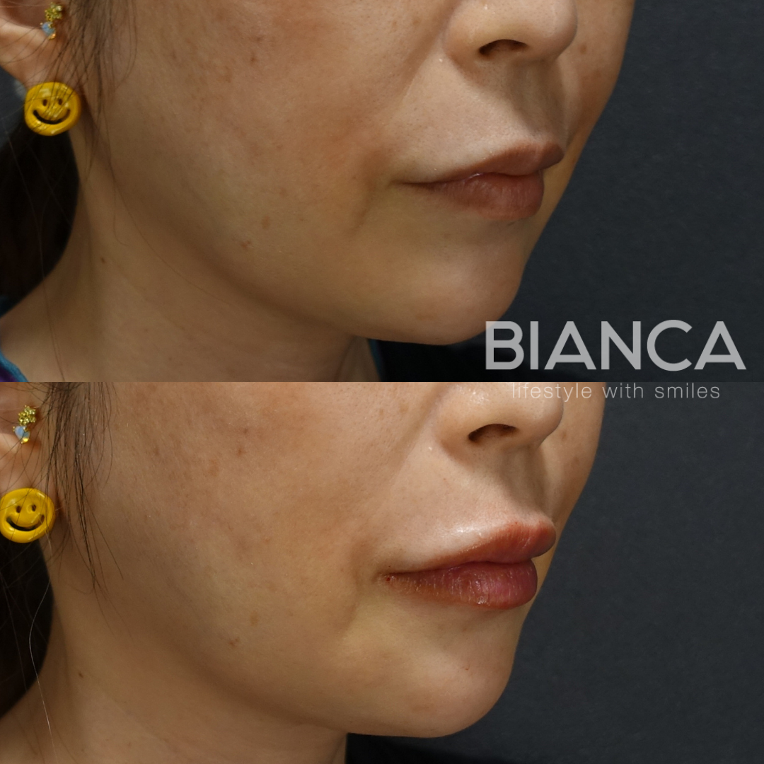 唇ヒアルロン酸で一気に洗練