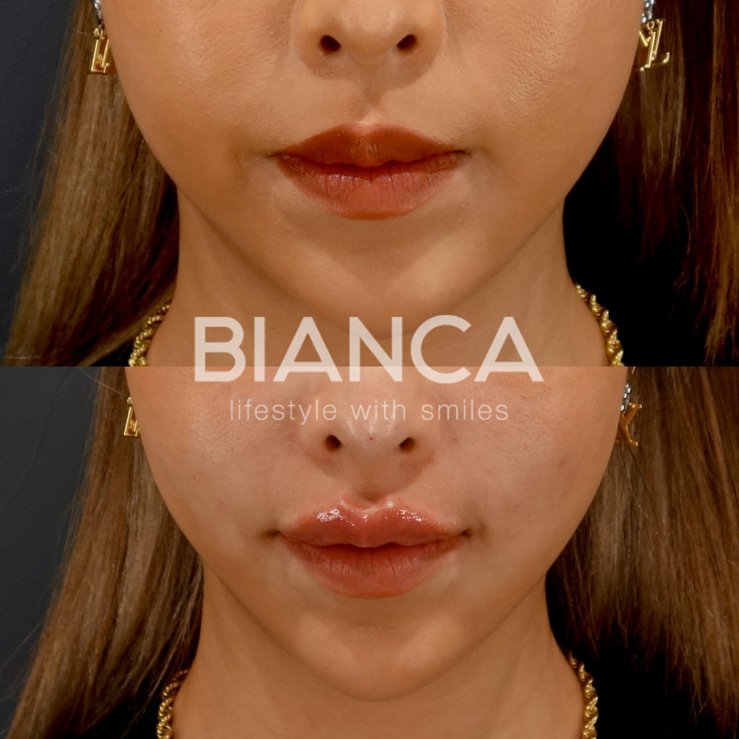 日本人向けのロシアンリップ ヒアルロン酸(唇)