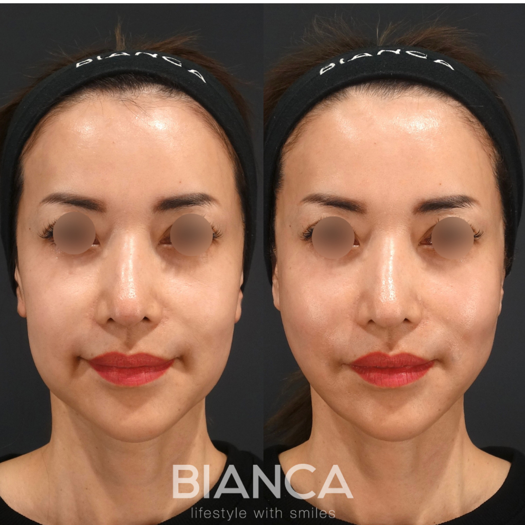 たるみ、面長を糸リフトで解決