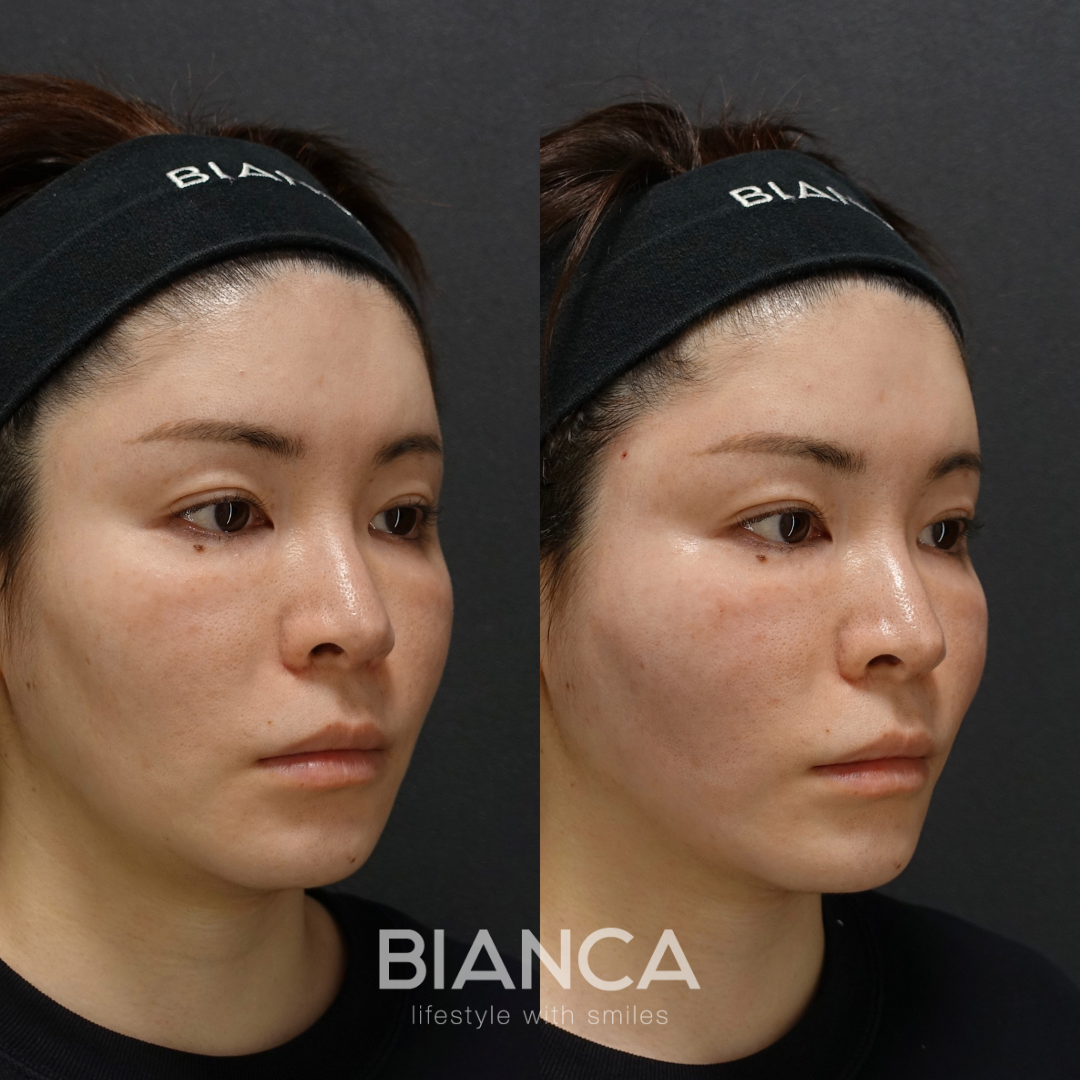 カスタマイズ糸リフト BIANCALIFT 10本 ・TESS LIFT 2本