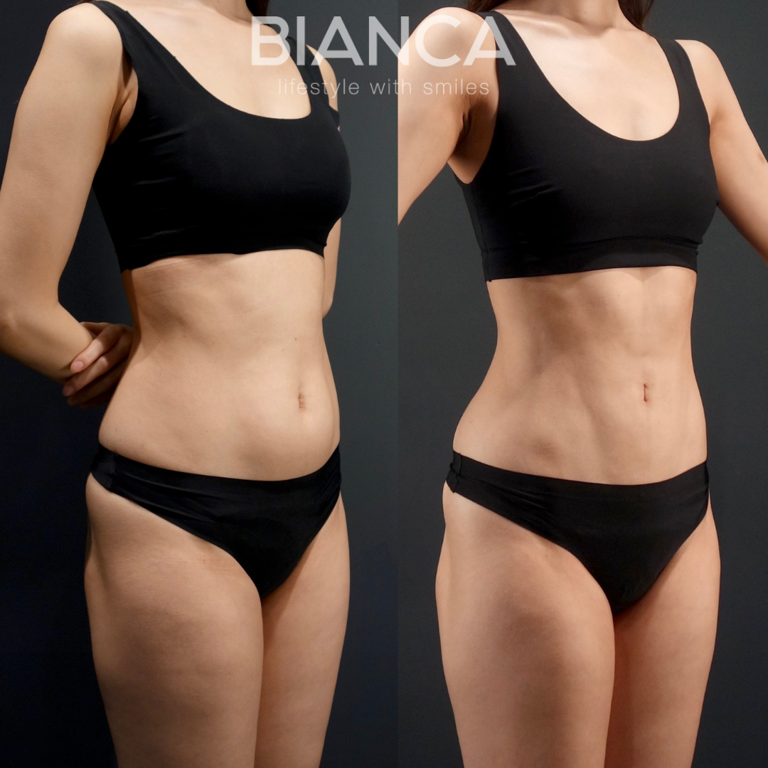 アブクラックス形成 ビアンカ銀座｜日本を代表する美容健康再生医療のクリニック