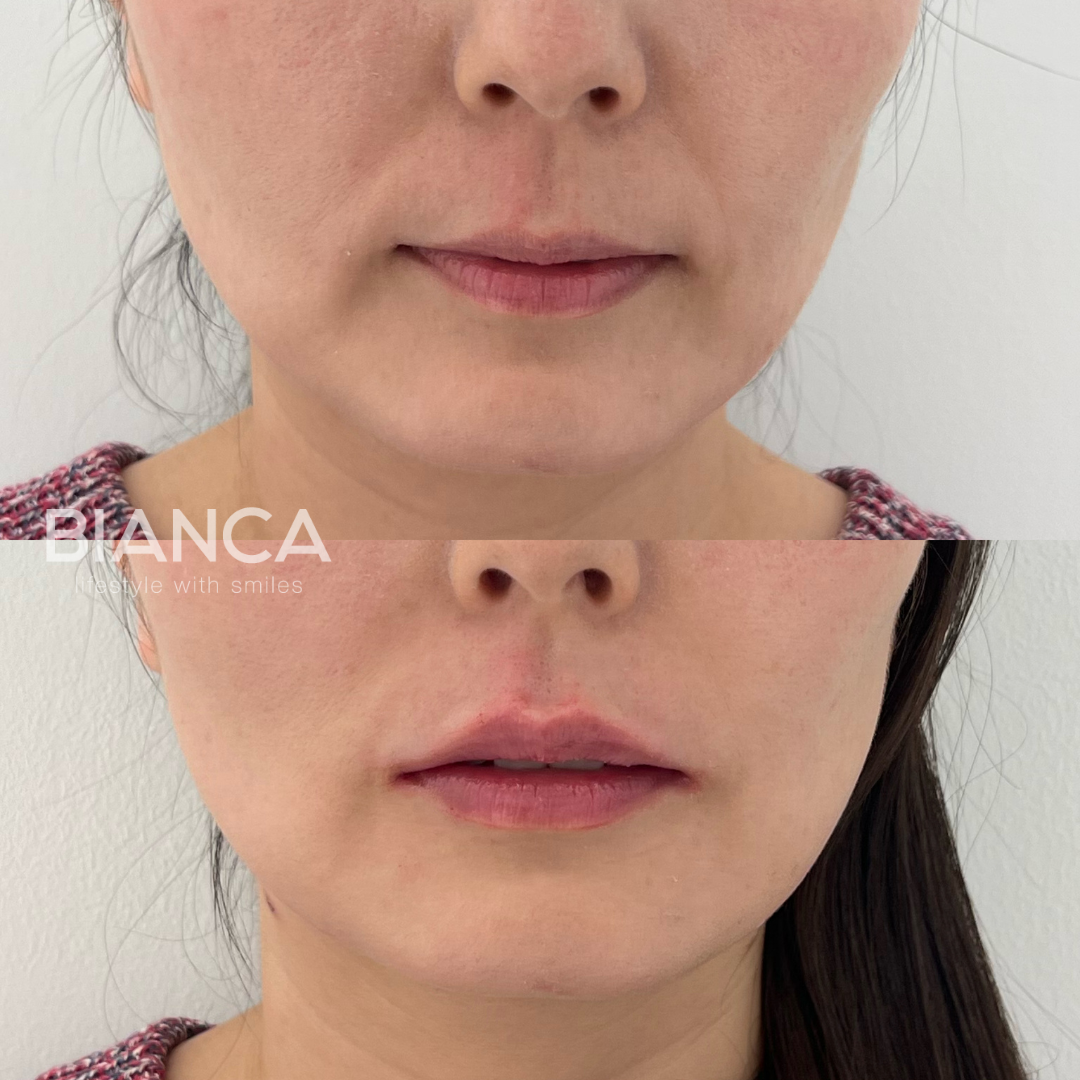 唇ヒアルロン酸でアンチエイジング効果