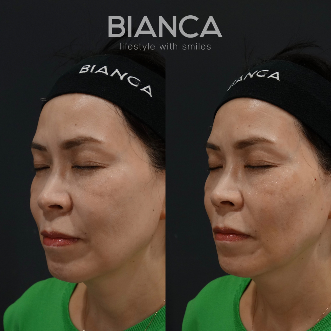 糸リフト２本で自然にリフトアップ