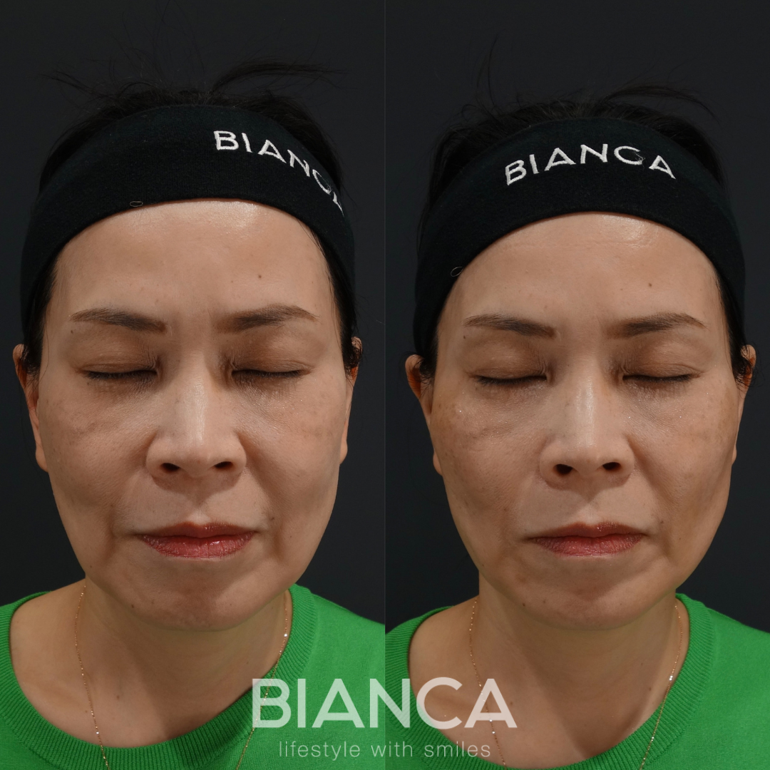 糸リフト２本で自然な輪郭に