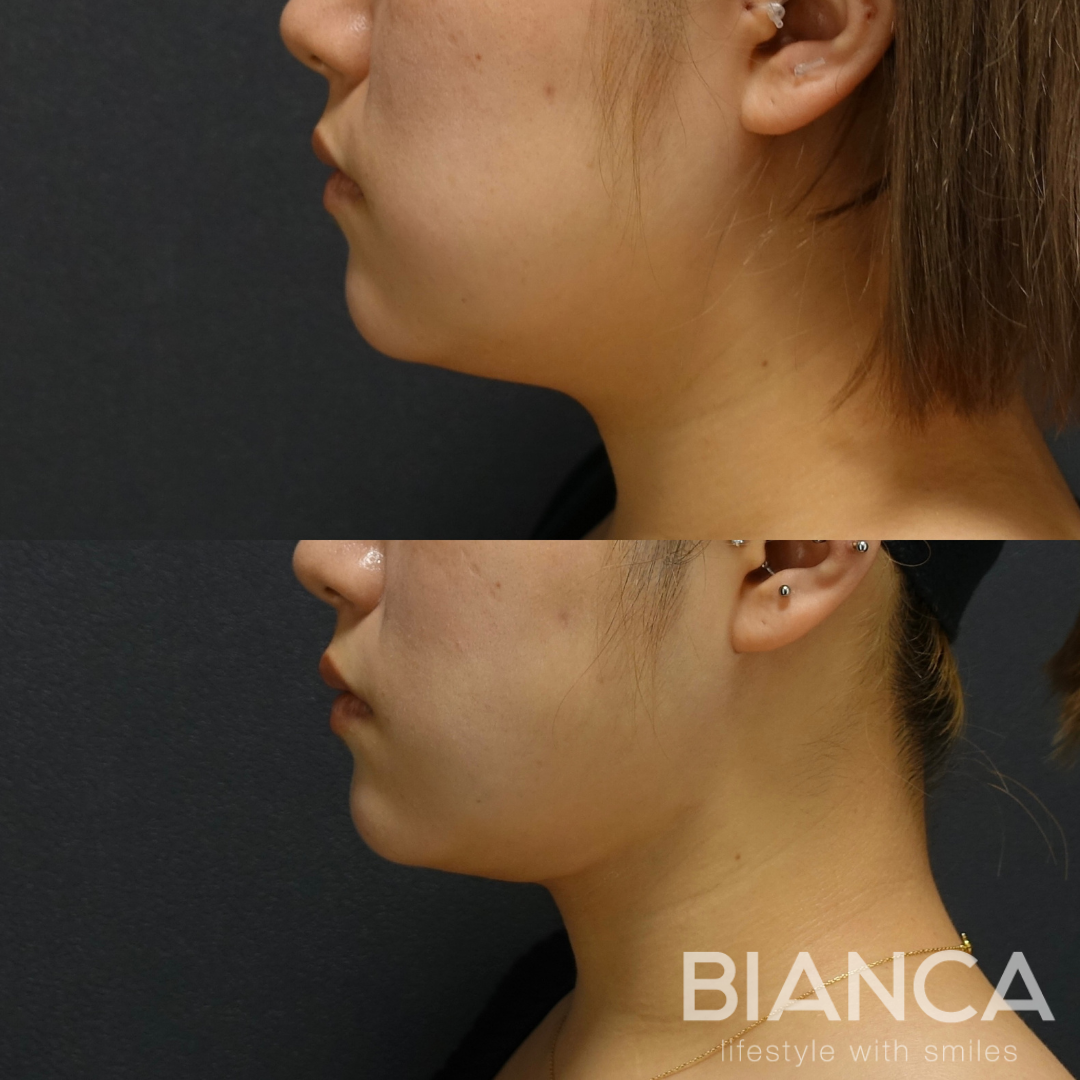 サクションリフトで美しい輪郭に