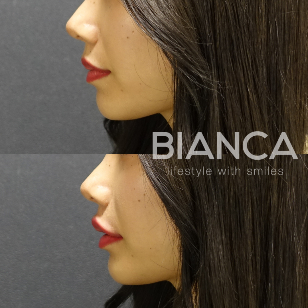 ヒアルロン酸で美リップ