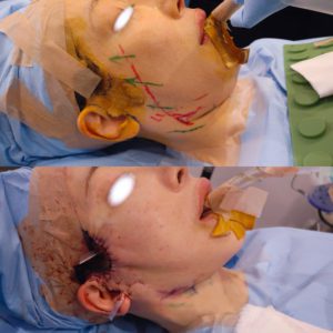 フェイスリフト