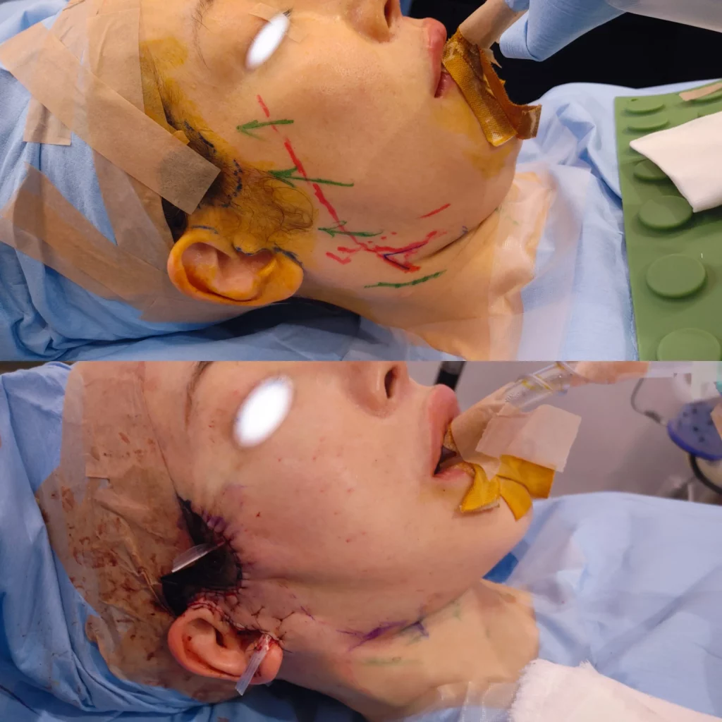 フェイスラインを整える外科手術