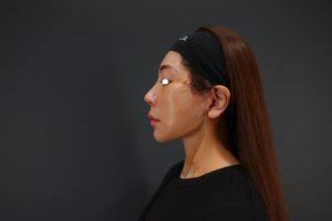 フェイスリフト手術