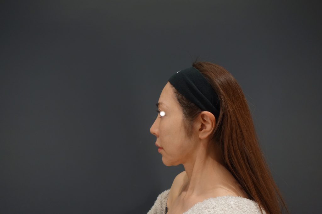 フェイスラインを整えた結果