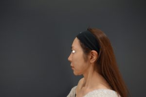 フェイスリフト手術