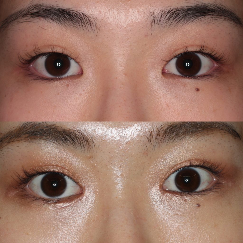 逆さ睫毛(まつ毛)