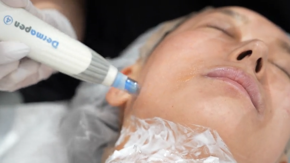 極細針で肌にアプローチ！CRFを効率よく真皮浅層に導入