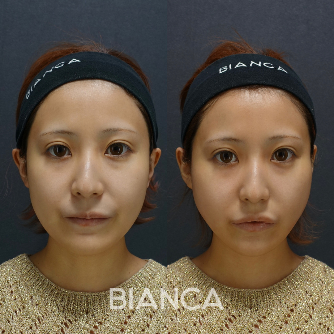 糸リフトで予防も兼ねてよりシャープに