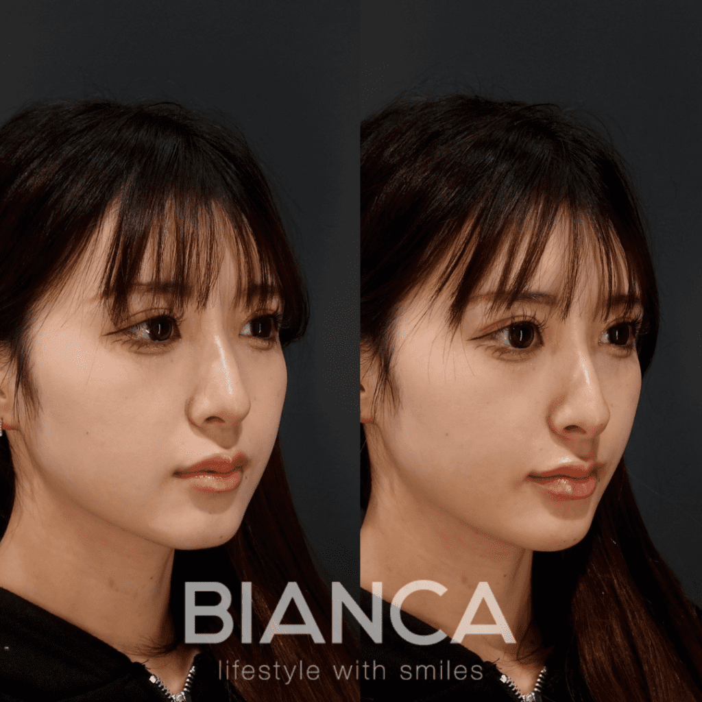 目元切開手術のダウンタイムはどのくらい？経過と過ごし方を写真付きで解説します🍃